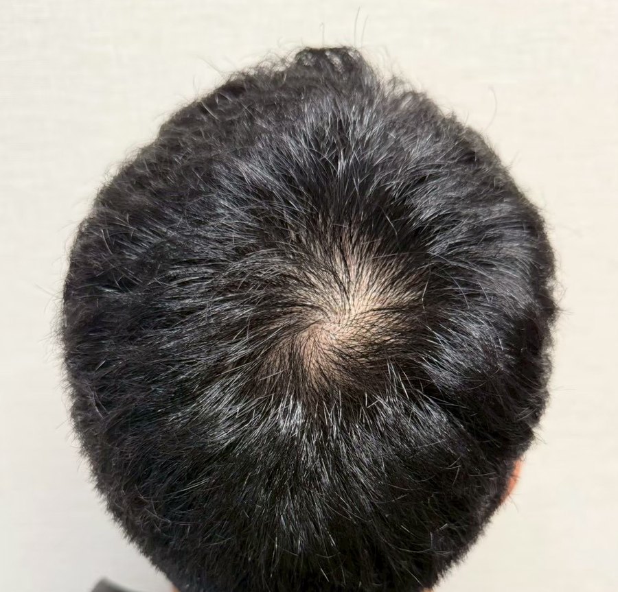 後頭部 施術前